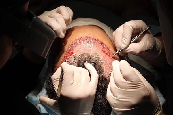 Transplant Surgery